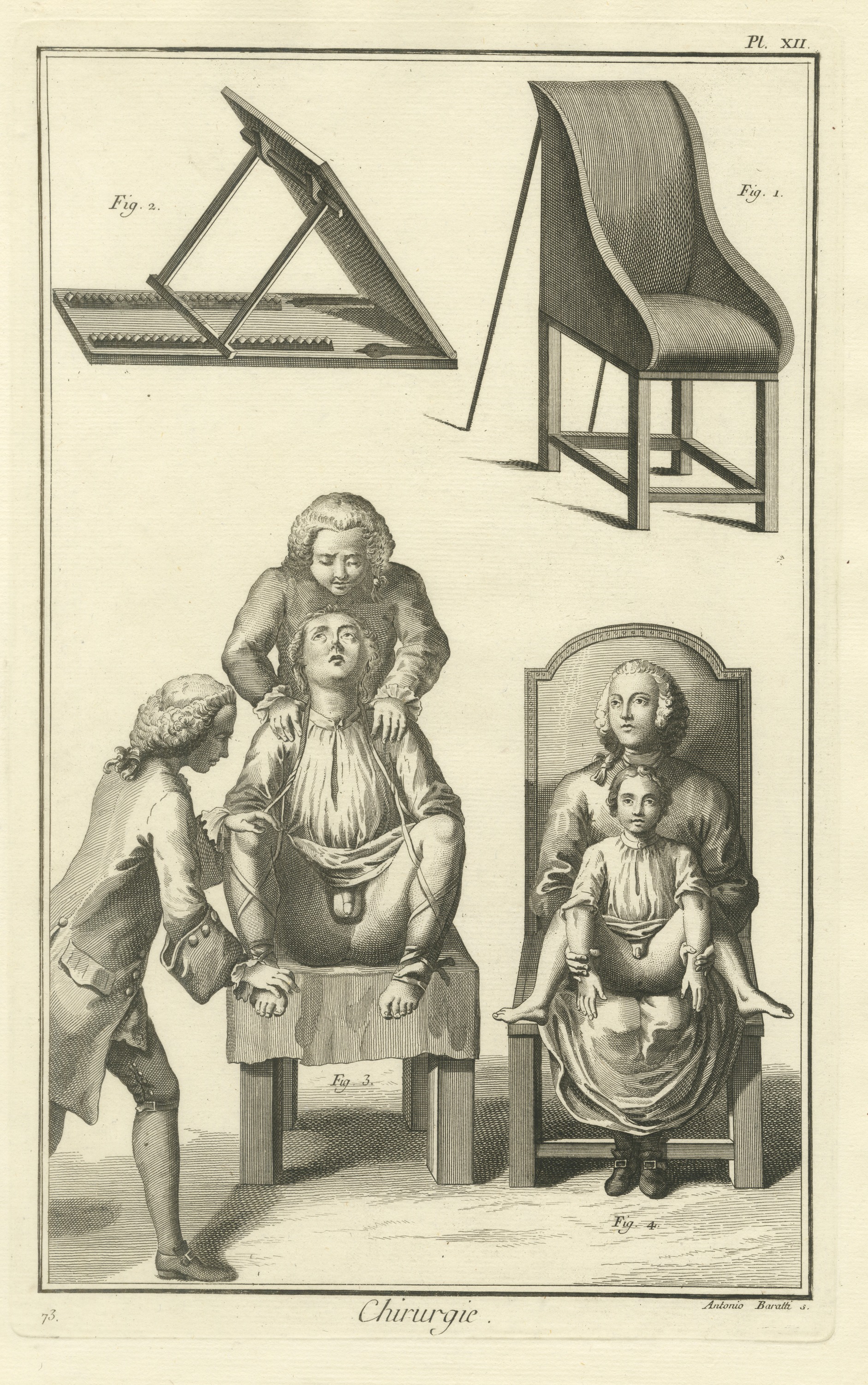 Operating Chair and Seated Patients, Diderot Chirurgie Plate XII, circa 1772