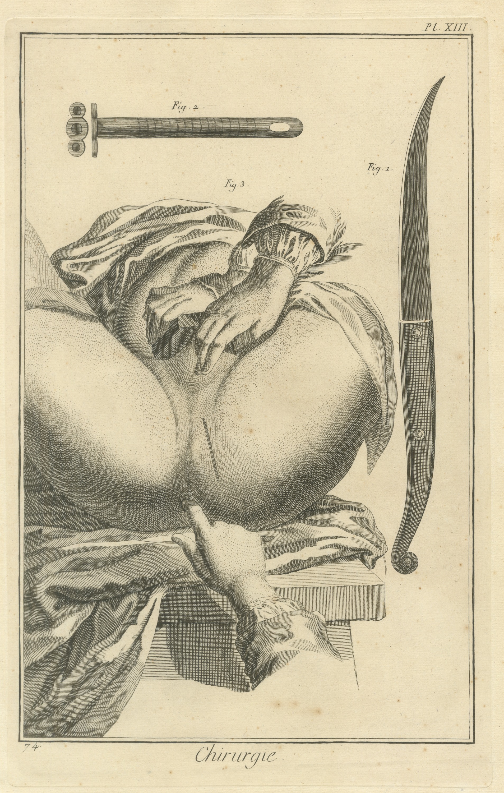 Anal Surgery with Bistoury and Cannula, Diderot Chirurgie Plate XIII, circa 1772