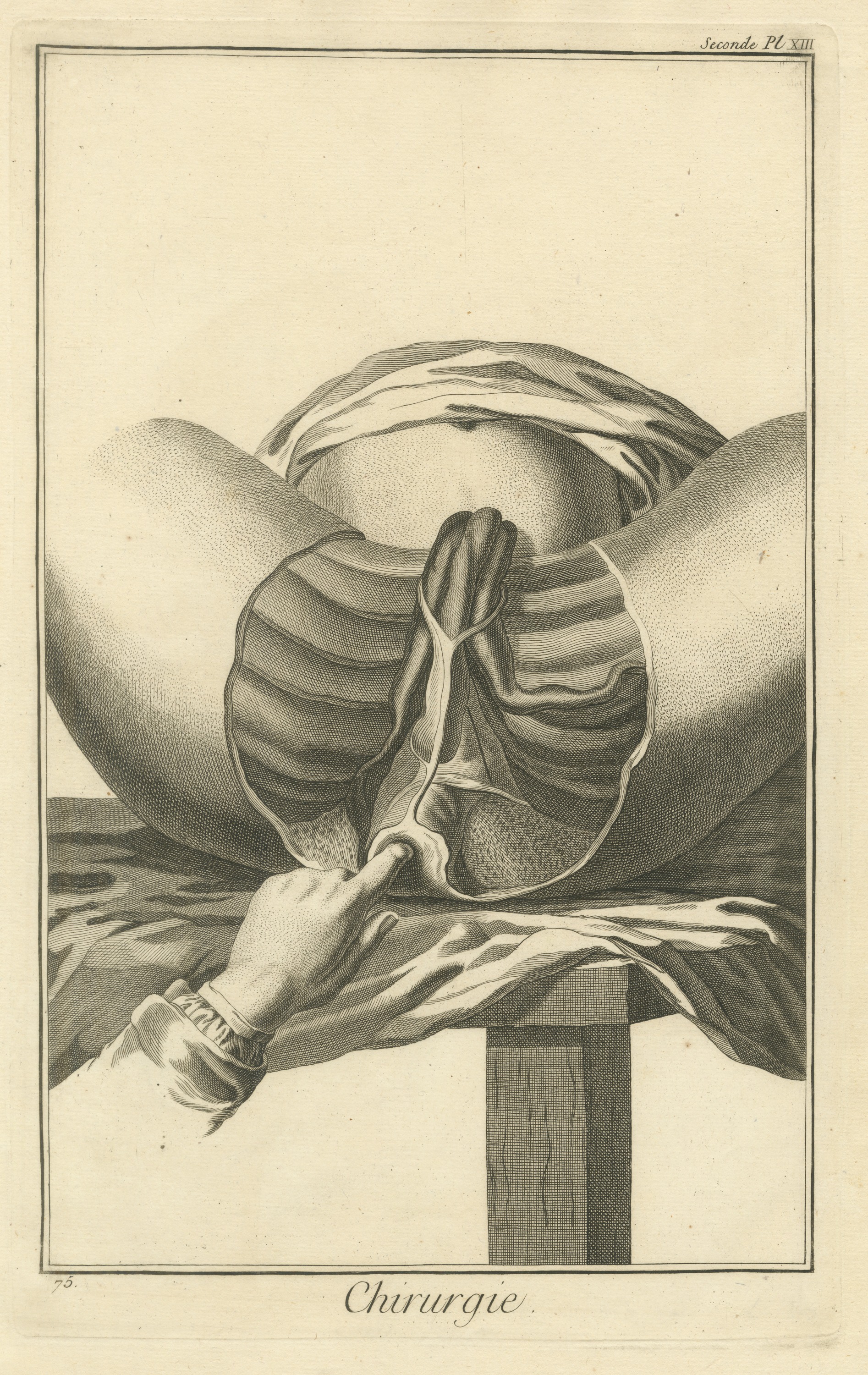 Dissection of the Male Perineum, Diderot Chirurgie Second Plate XIII, circa 1772