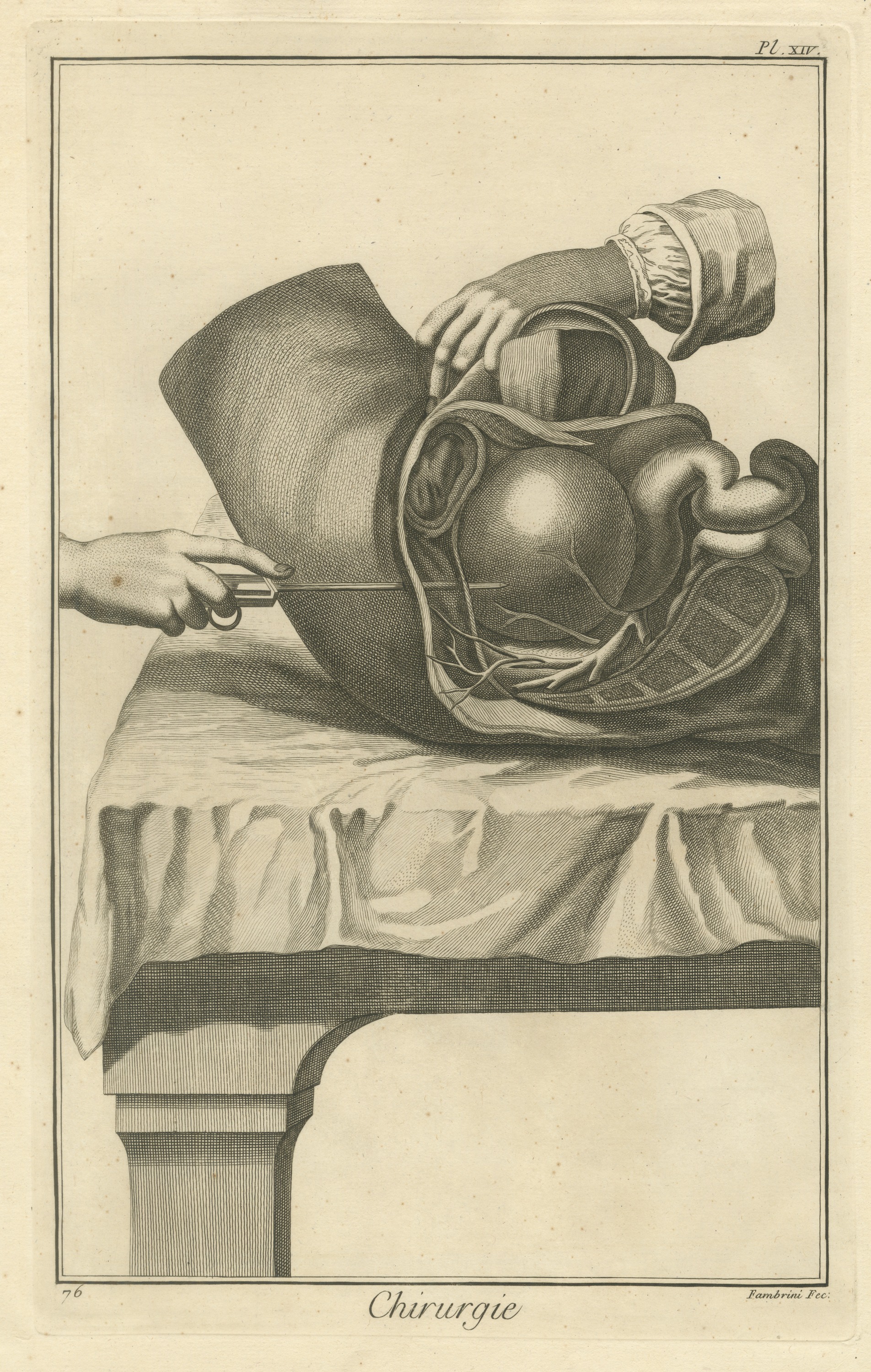Opened Abdomen and Bladder Dissection, Diderot Chirurgie Plate XIV, circa 1772