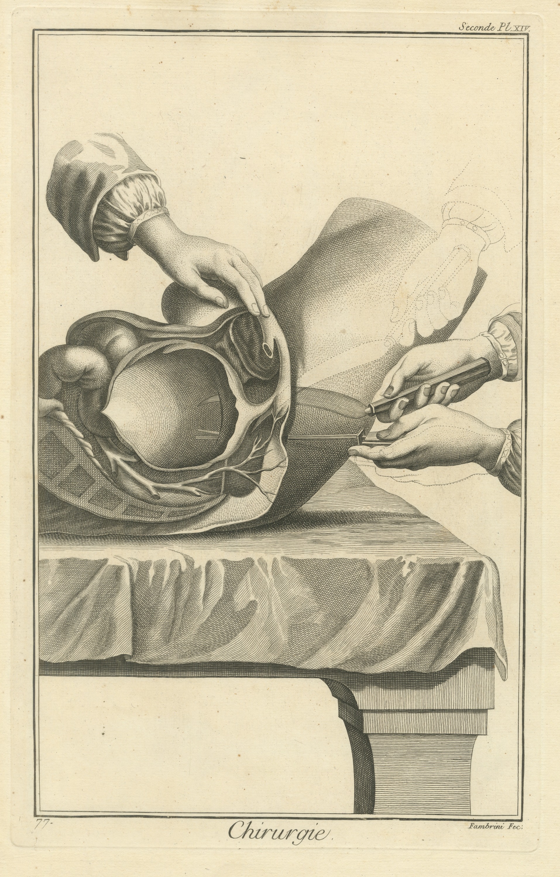 Opened Bladder with Instruments, Diderot Chirurgie Second Plate XIV, circa 1772