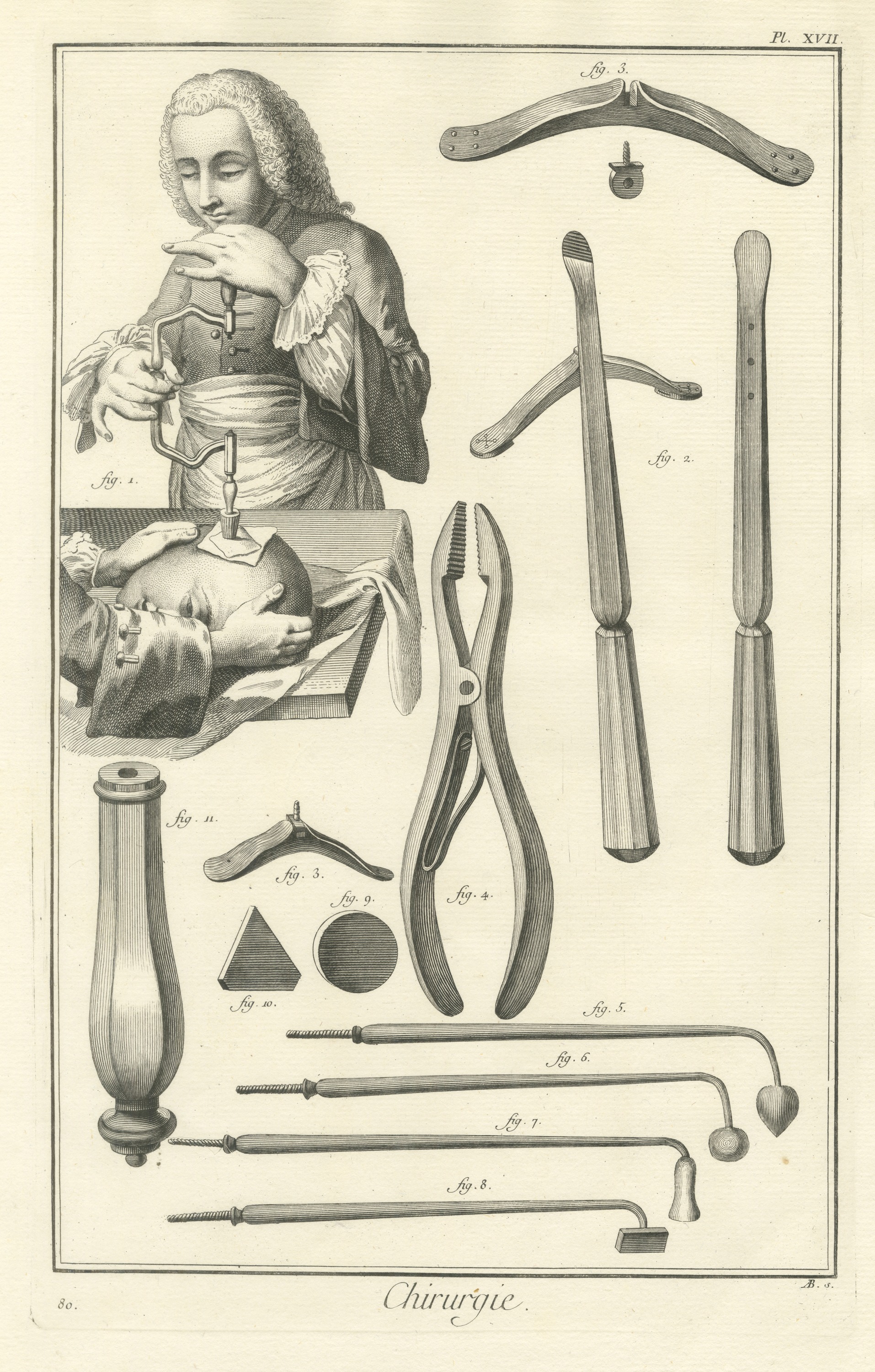 Trepanning the Skull and Cautery Irons, Diderot Chirurgie Plate XVII, circa 1772