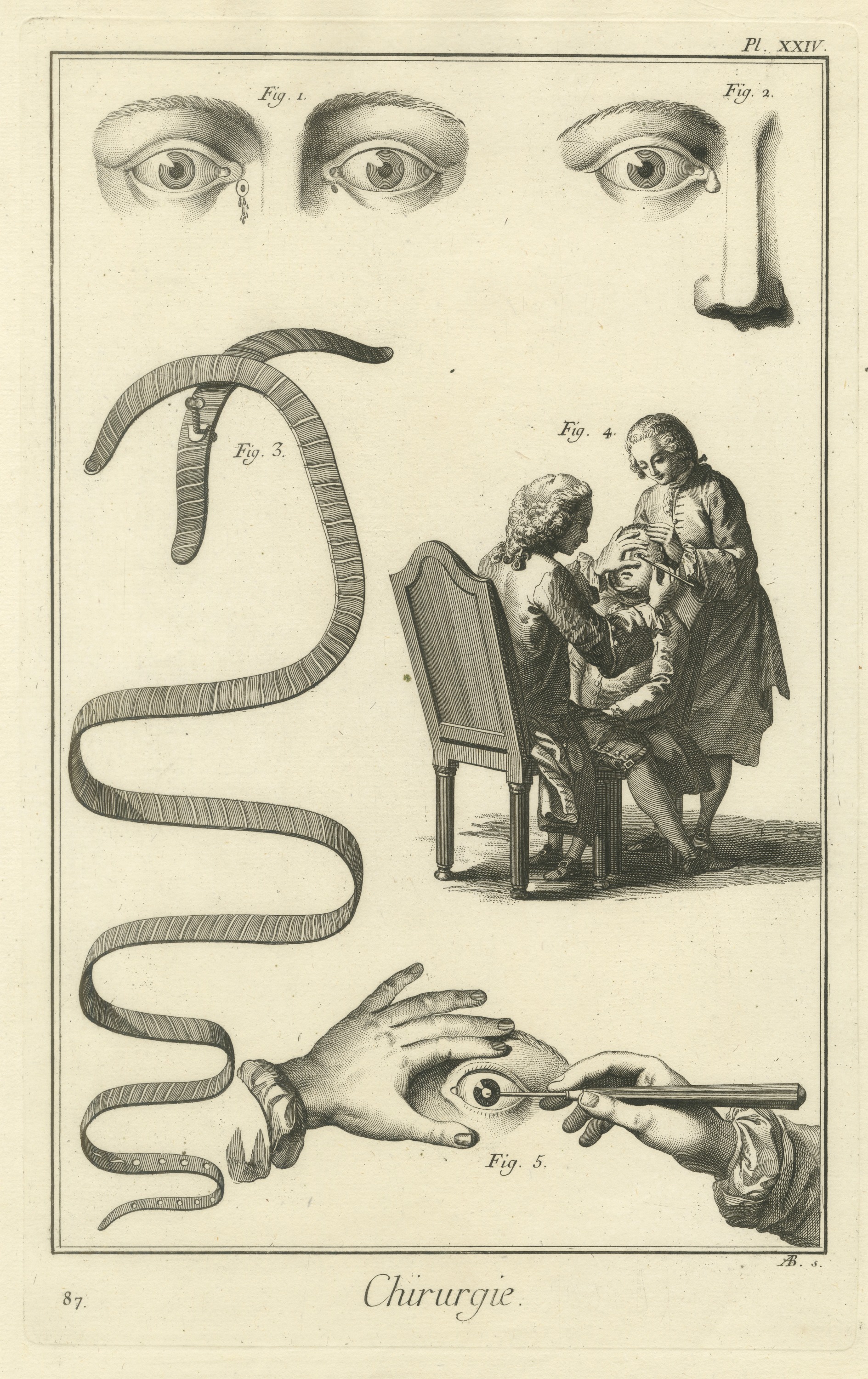 Eye Studies and Eye Operation, Diderot Chirurgie Plate XXIV, circa 1772