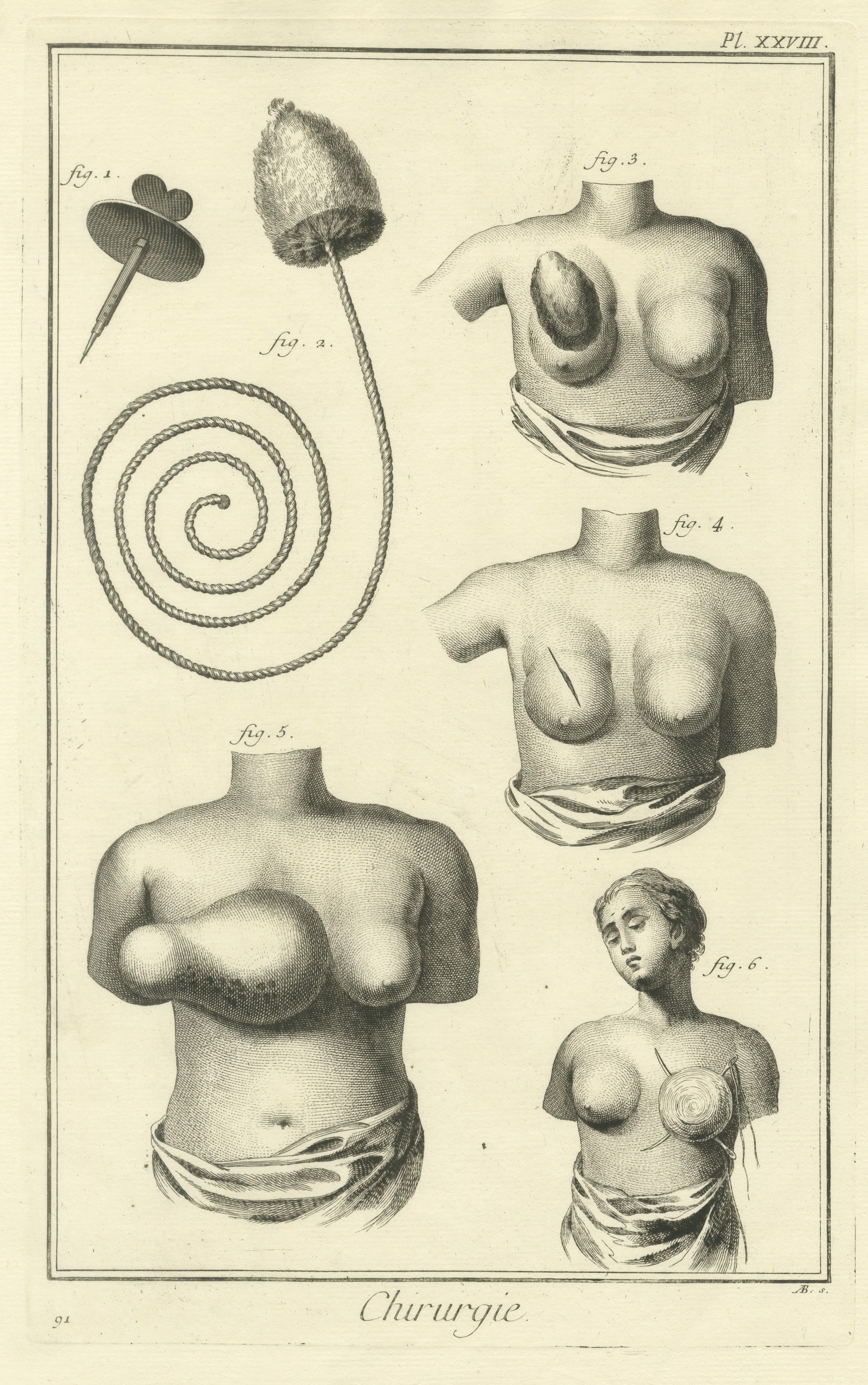 Breast Conditions and Treatment, Diderot Chirurgie Plate XXVIII, circa 1772
