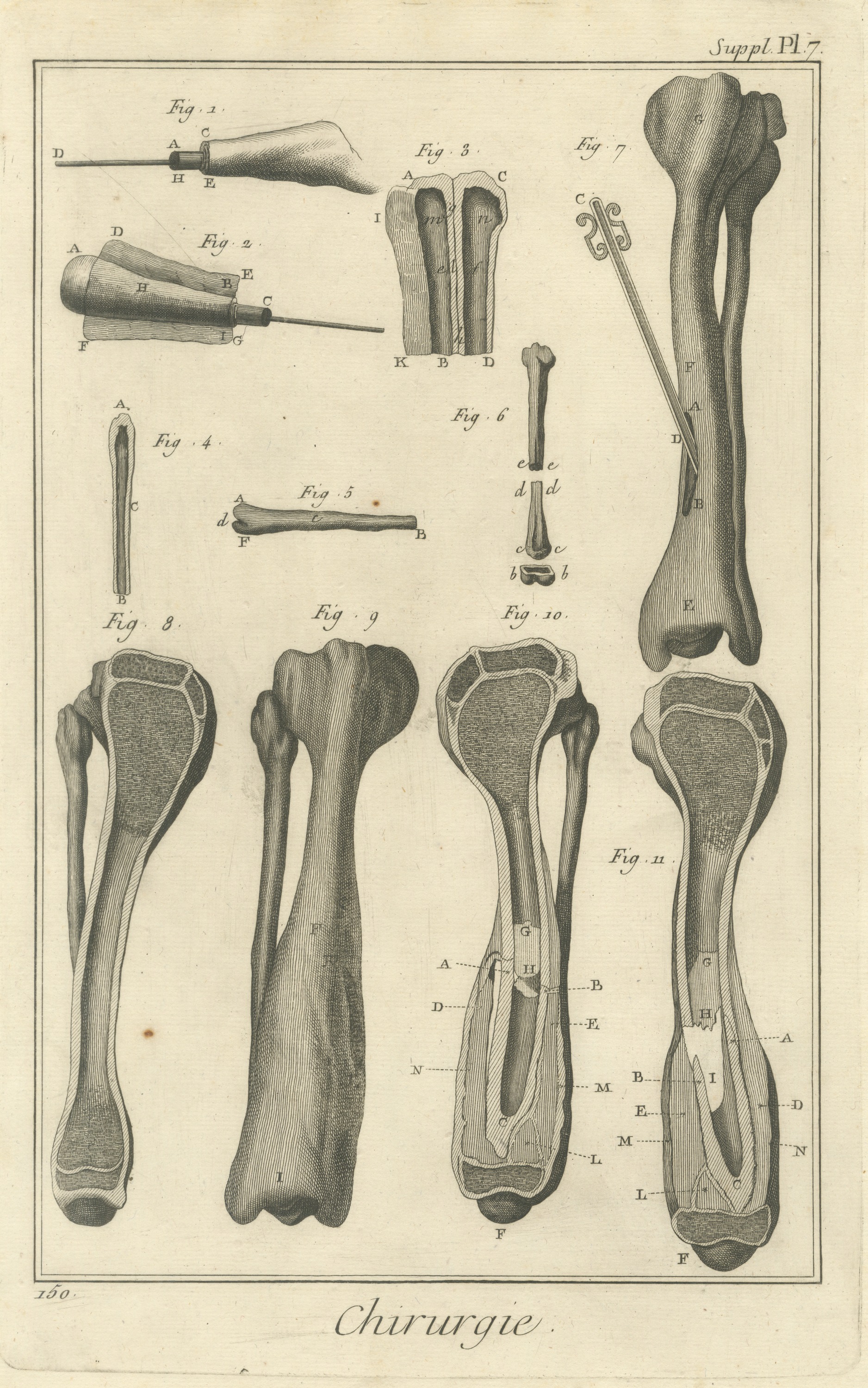 Long Bone Sections, Diderot Chirurgie Supplement Plate 7, circa 1778