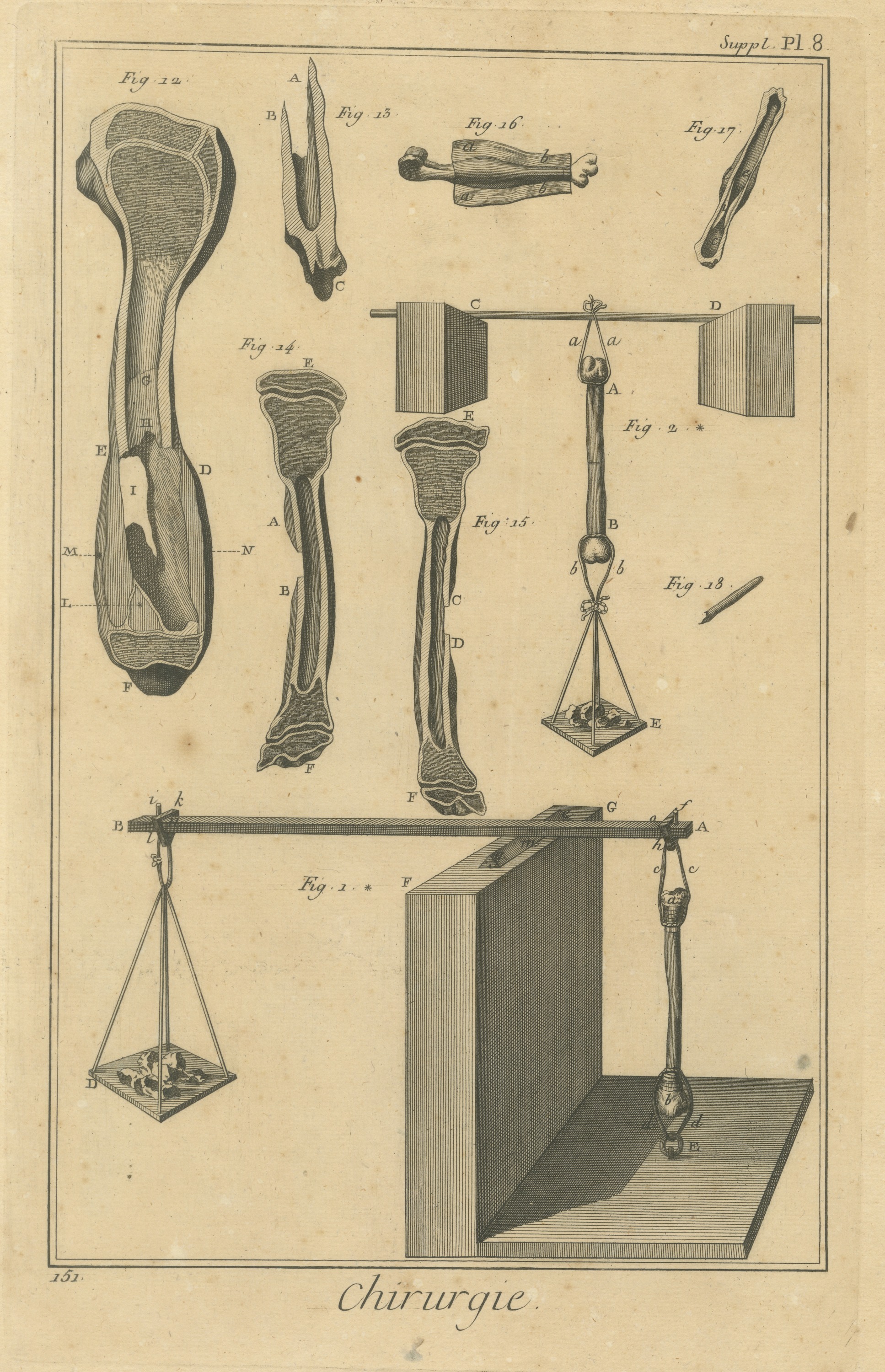Bones Under Weights, Diderot Chirurgie Supplement Plate 8, circa 1778