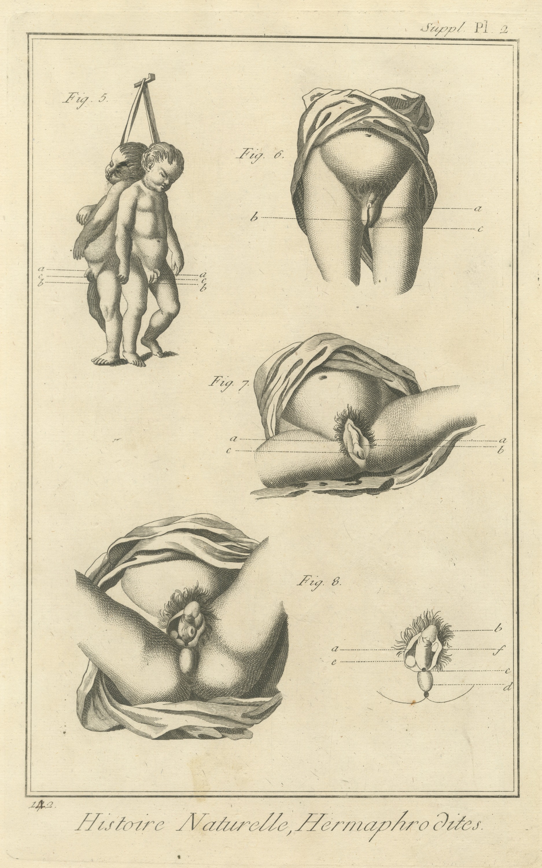 Conjoined Infants Study, Diderot Hermaphrodites Supplement Plate 2, circa 1778